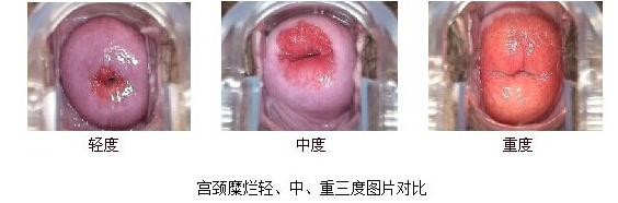 宫颈糜烂